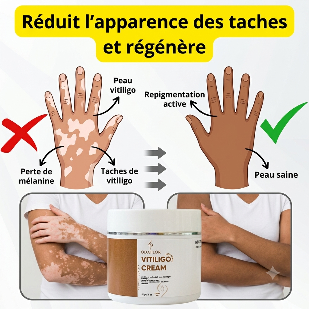 ODAFLOR VITILIGO CREAM